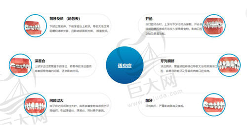 舌侧矫正适应范围