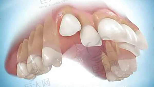 每个人牙齿错颌畸形情况不同