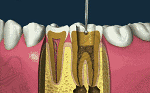 进行根管治疗中的牙齿