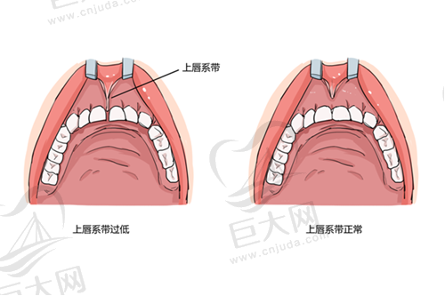 上唇系带