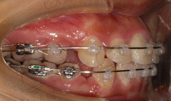 半隐形矫正牙套佩戴