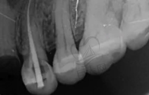 拍摄牙片确定受损根管数量