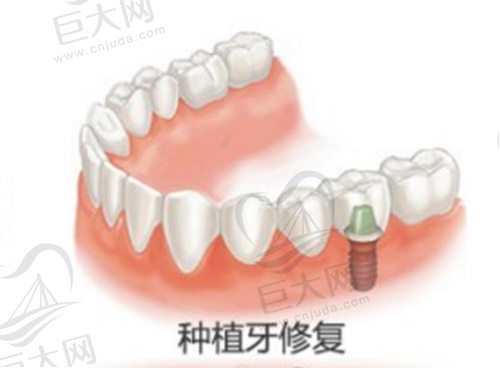 种植牙修复