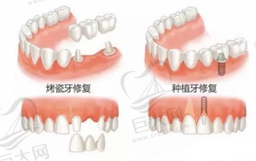 牙齿修复