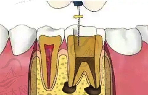 根管治疗卡通示范图