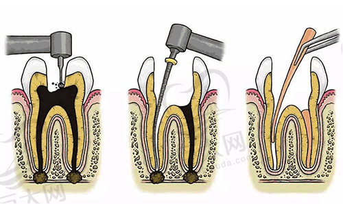 牙齿根管治疗步骤过程