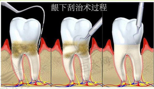 龈下刮治