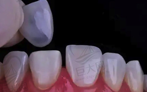 进行牙齿瓷贴面修复