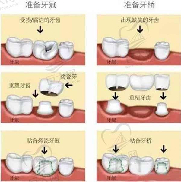 镶牙的全部过程图解