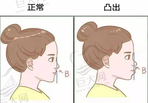 正常嘴和凸嘴对比