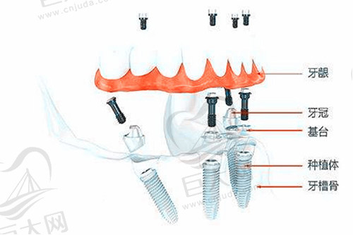 全口种植牙