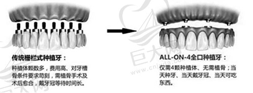 全口种植牙