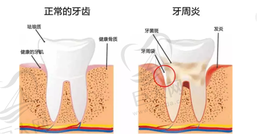 牙周炎