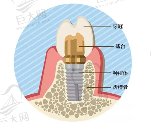 种植牙