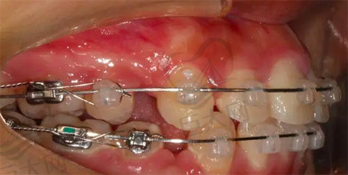 正畸收缝