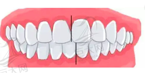 牙齿中线