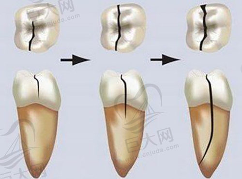牙齿裂缝