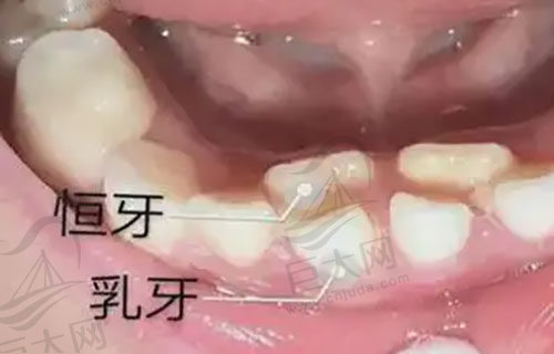儿童双排牙症状