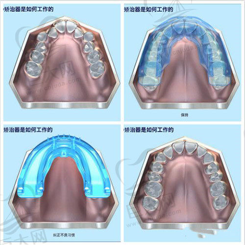 儿童矫治器