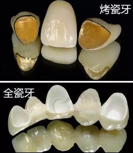 牙冠种类