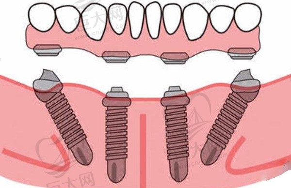 all-on-4种植牙