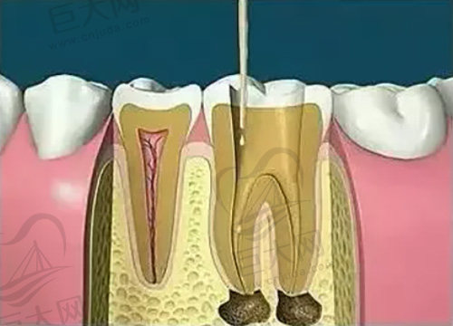 根管治疗