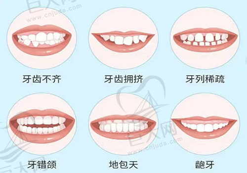 牙齿矫正的适用症