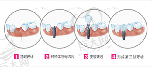 牙齿种植流程