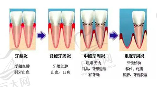 牙周炎变化图