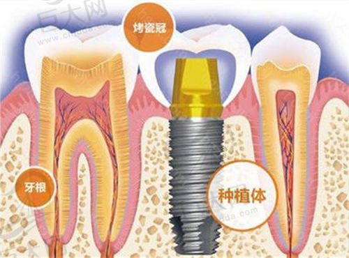 种植牙