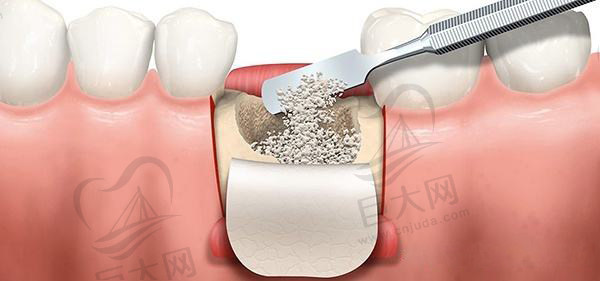 种植牙骨粉骨膜