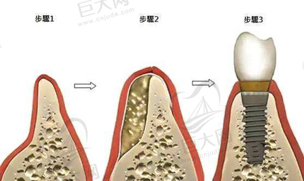 种植牙骨粉和骨膜在什么情况下使用