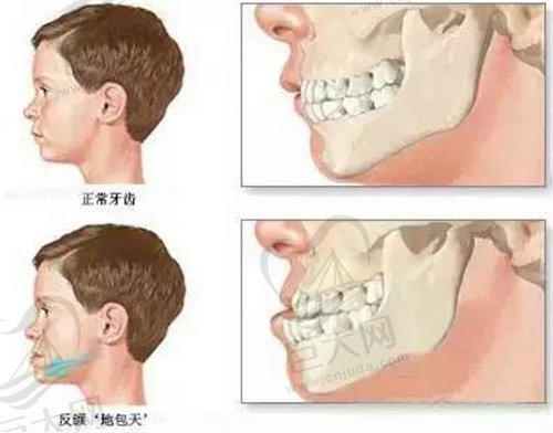 下颌后缩