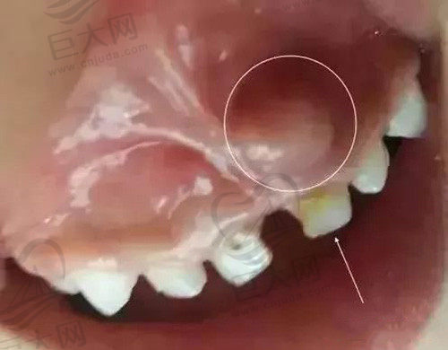 牙龈上长包