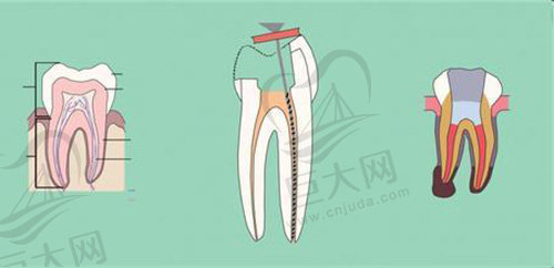 根管治疗