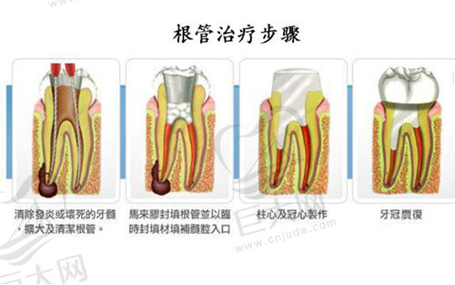 根管治疗