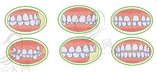 牙齿不齐
