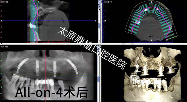 太原鼎植口腔医院种植