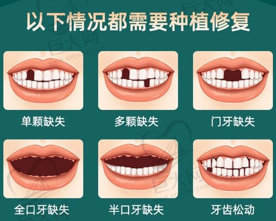 瑞士ITI种植牙适应症