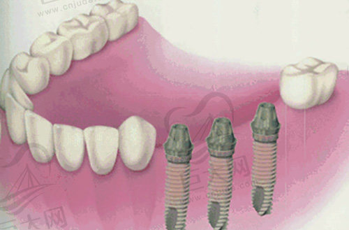 牙缺失种植修复示范图