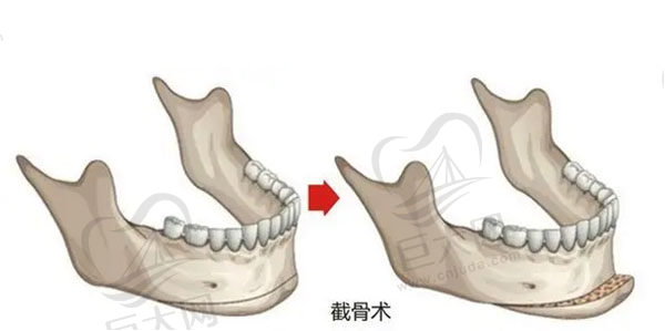 上海下颌角磨骨手术