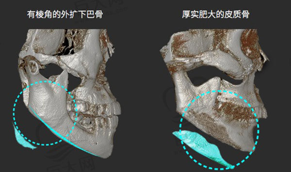 下颌骨3D缩小术