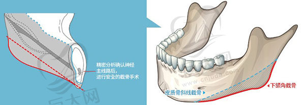 上海下颌角磨骨医生技术
