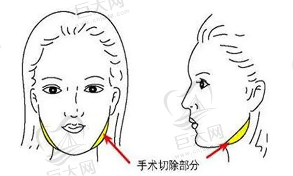 上海下颌角磨骨医生技术