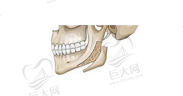 上海下颌角磨骨医生技术