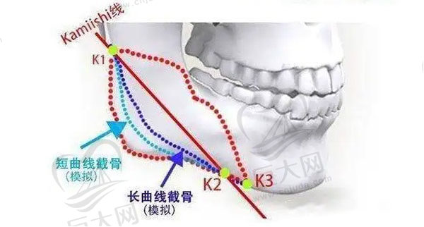 上海下颌角磨骨医生技术