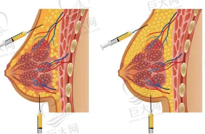 北京自体脂肪隆胸谁做的好