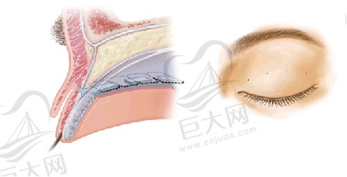 双眼皮手术