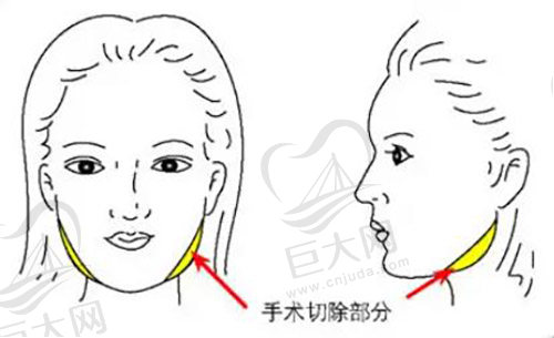 下颌角截骨部位