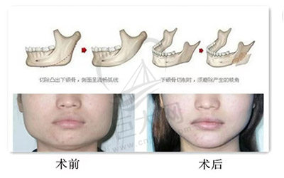 下巴手术示意图